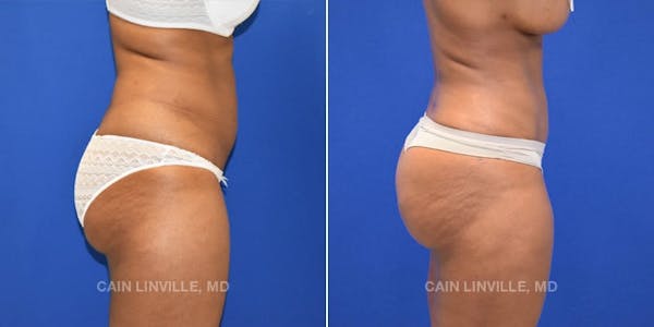 Mini Tummy Tuck Before & After Gallery - Patient 8522289 - Image 5