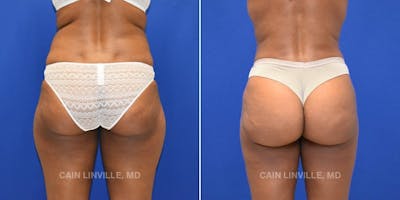 Mini Tummy Tuck Before & After Gallery - Patient 8522289 - Image 6