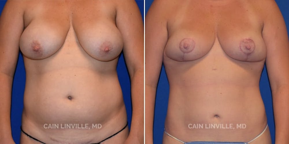 Mommy Makeover Before & After Gallery - Patient 8522304 - Image 1