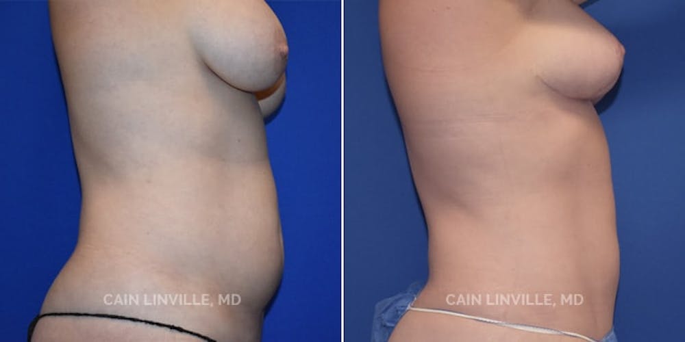 Mommy Makeover Before & After Gallery - Patient 8522304 - Image 2