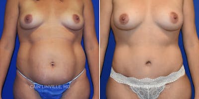 Mommy Makeover Before & After Gallery - Patient 8522317 - Image 1