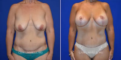 Mommy Makeover Before & After Gallery - Patient 8522343 - Image 1