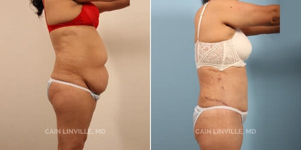 Tummy Tuck (Abdominoplasty) Before & After Gallery - Patient 8522356 - Image 1