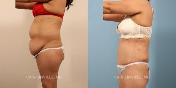 Tummy Tuck (Abdominoplasty) Before & After Gallery - Patient 8522356 - Image 2
