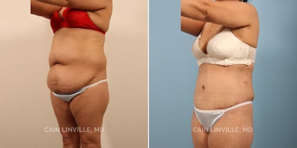 Tummy Tuck (Abdominoplasty) Before & After Gallery - Patient 8522356 - Image 3