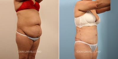 Tummy Tuck (Abdominoplasty) Before & After Gallery - Patient 8522356 - Image 4