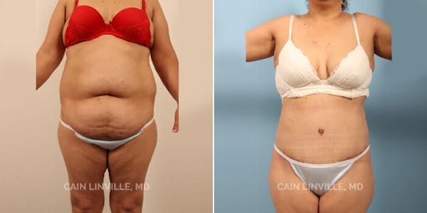 Tummy Tuck (Abdominoplasty) Before & After Gallery - Patient 8522356 - Image 5