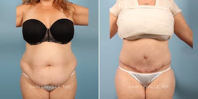 Tummy Tuck (Abdominoplasty) Before & After Gallery - Patient 8522360 - Image 1