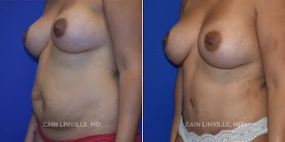 Tummy Tuck (Abdominoplasty) Before & After Gallery - Patient 8522370 - Image 2