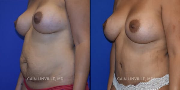 Tummy Tuck (Abdominoplasty) Before & After Gallery - Patient 8522370 - Image 2