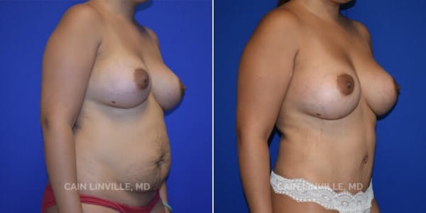 Tummy Tuck (Abdominoplasty) Before & After Gallery - Patient 8522370 - Image 3