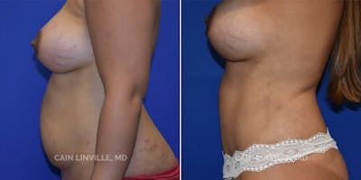 Tummy Tuck (Abdominoplasty) Before & After Gallery - Patient 8522370 - Image 4
