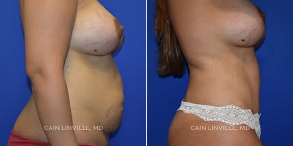 Tummy Tuck (Abdominoplasty) Before & After Gallery - Patient 8522370 - Image 5