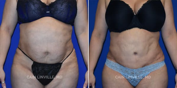 Tummy Tuck (Abdominoplasty) Before & After Gallery - Patient 8522381 - Image 1