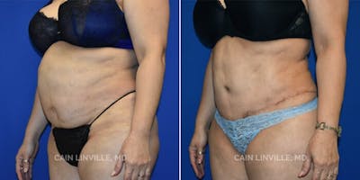 Tummy Tuck (Abdominoplasty) Before & After Gallery - Patient 8522381 - Image 2