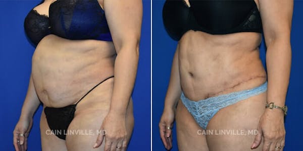 Tummy Tuck (Abdominoplasty) Before & After Gallery - Patient 8522381 - Image 2