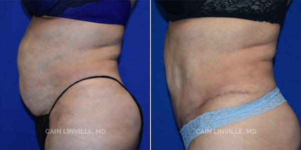 Tummy Tuck (Abdominoplasty) Before & After Gallery - Patient 8522381 - Image 3