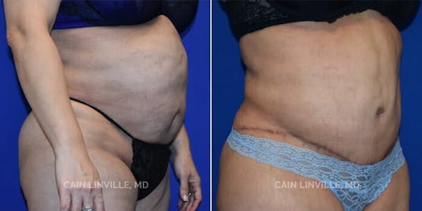 Tummy Tuck (Abdominoplasty) Before & After Gallery - Patient 8522381 - Image 4