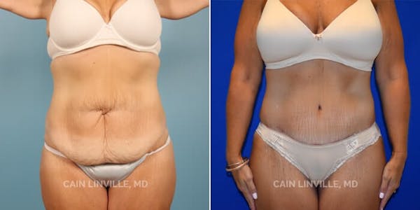 Tummy Tuck (Abdominoplasty) Before & After Gallery - Patient 8522394 - Image 1