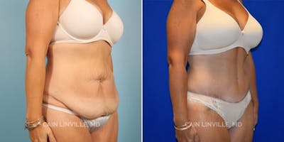 Tummy Tuck (Abdominoplasty) Before & After Gallery - Patient 8522394 - Image 2