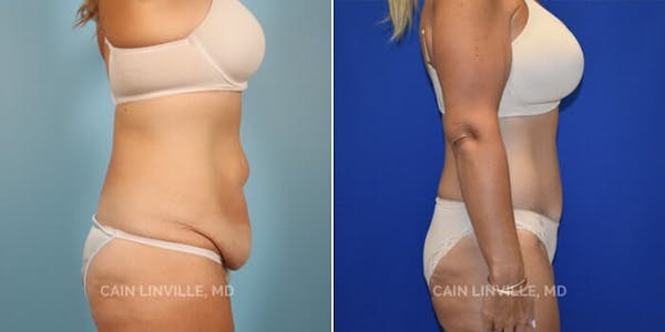 Tummy Tuck (Abdominoplasty) Before & After Gallery - Patient 8522394 - Image 3