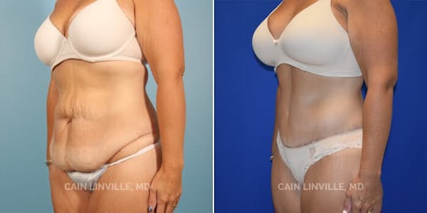Tummy Tuck (Abdominoplasty) Before & After Gallery - Patient 8522394 - Image 4