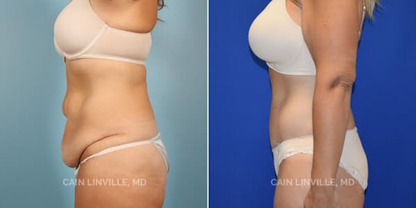 Tummy Tuck (Abdominoplasty) Before & After Gallery - Patient 8522394 - Image 5