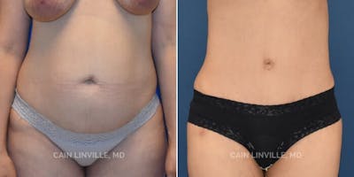 Tummy Tuck (Abdominoplasty) Before & After Gallery - Patient 8522402 - Image 1