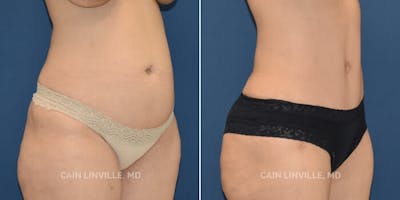 Tummy Tuck (Abdominoplasty) Before & After Gallery - Patient 8522402 - Image 2
