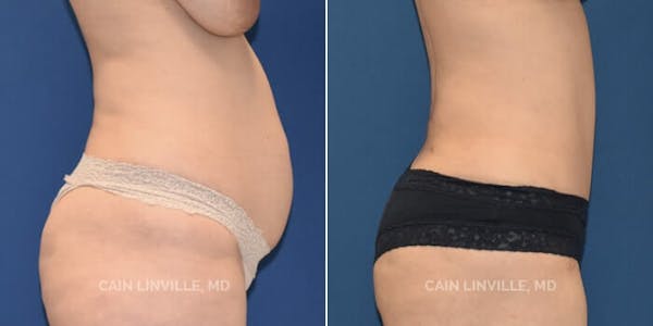 Tummy Tuck (Abdominoplasty) Before & After Gallery - Patient 8522402 - Image 3