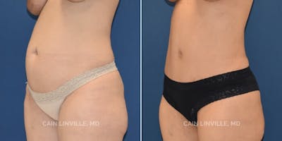 Tummy Tuck (Abdominoplasty) Before & After Gallery - Patient 8522402 - Image 4