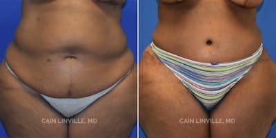 Tummy Tuck (Abdominoplasty) Before & After Gallery - Patient 8522414 - Image 1