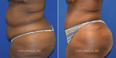 Tummy Tuck (Abdominoplasty) Before & After Gallery - Patient 8522414 - Image 2