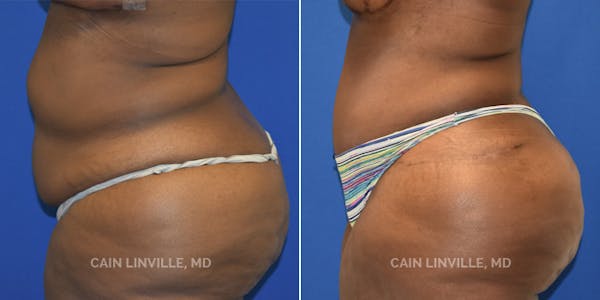 Tummy Tuck (Abdominoplasty) Before & After Gallery - Patient 8522414 - Image 2