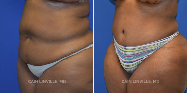 Tummy Tuck (Abdominoplasty) Before & After Gallery - Patient 8522414 - Image 3