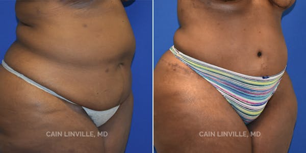 Tummy Tuck (Abdominoplasty) Before & After Gallery - Patient 8522414 - Image 4