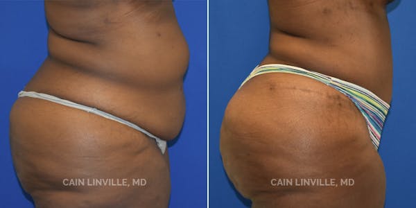 Tummy Tuck (Abdominoplasty) Before & After Gallery - Patient 8522414 - Image 5