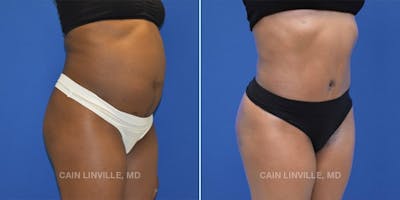 Tummy Tuck (Abdominoplasty) Before & After Gallery - Patient 8522537 - Image 1