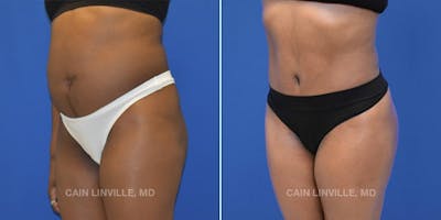 Tummy Tuck (Abdominoplasty) Before & After Gallery - Patient 8522537 - Image 2