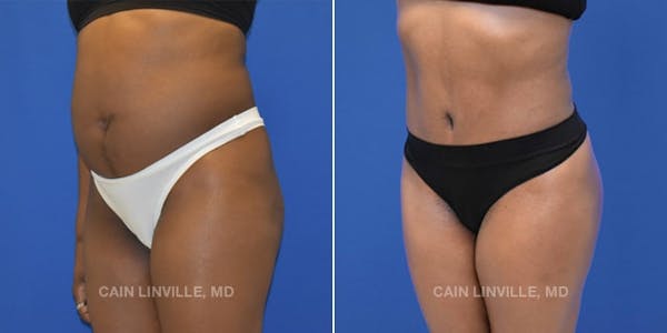 Tummy Tuck (Abdominoplasty) Before & After Gallery - Patient 8522537 - Image 2