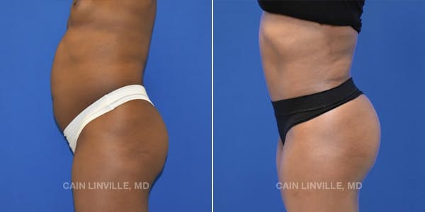 Tummy Tuck (Abdominoplasty) Before & After Gallery - Patient 8522537 - Image 3