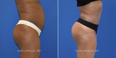 Tummy Tuck (Abdominoplasty) Before & After Gallery - Patient 8522537 - Image 4