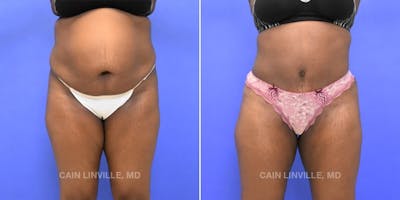 Tummy Tuck (Abdominoplasty) Before & After Gallery - Patient 8522552 - Image 1