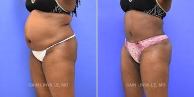 Tummy Tuck (Abdominoplasty) Before & After Gallery - Patient 8522552 - Image 2