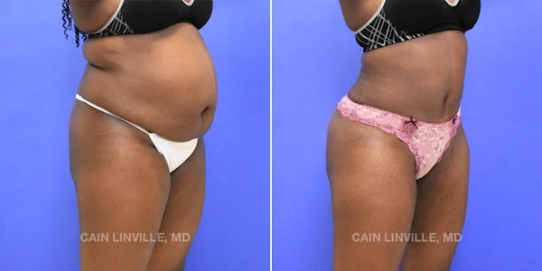 Tummy Tuck (Abdominoplasty) Before & After Gallery - Patient 8522552 - Image 3