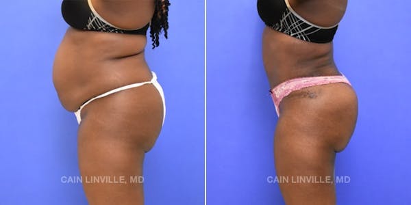 Tummy Tuck (Abdominoplasty) Before & After Gallery - Patient 8522552 - Image 4