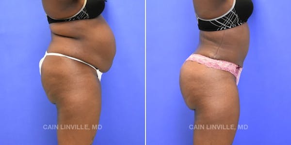 Tummy Tuck (Abdominoplasty) Before & After Gallery - Patient 8522552 - Image 5