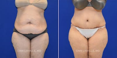 Tummy Tuck (Abdominoplasty) Before & After Gallery - Patient 8522673 - Image 1
