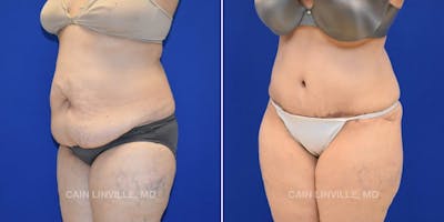 Tummy Tuck (Abdominoplasty) Before & After Gallery - Patient 8522673 - Image 2