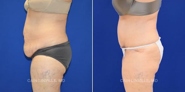 Tummy Tuck (Abdominoplasty) Before & After Gallery - Patient 8522673 - Image 3